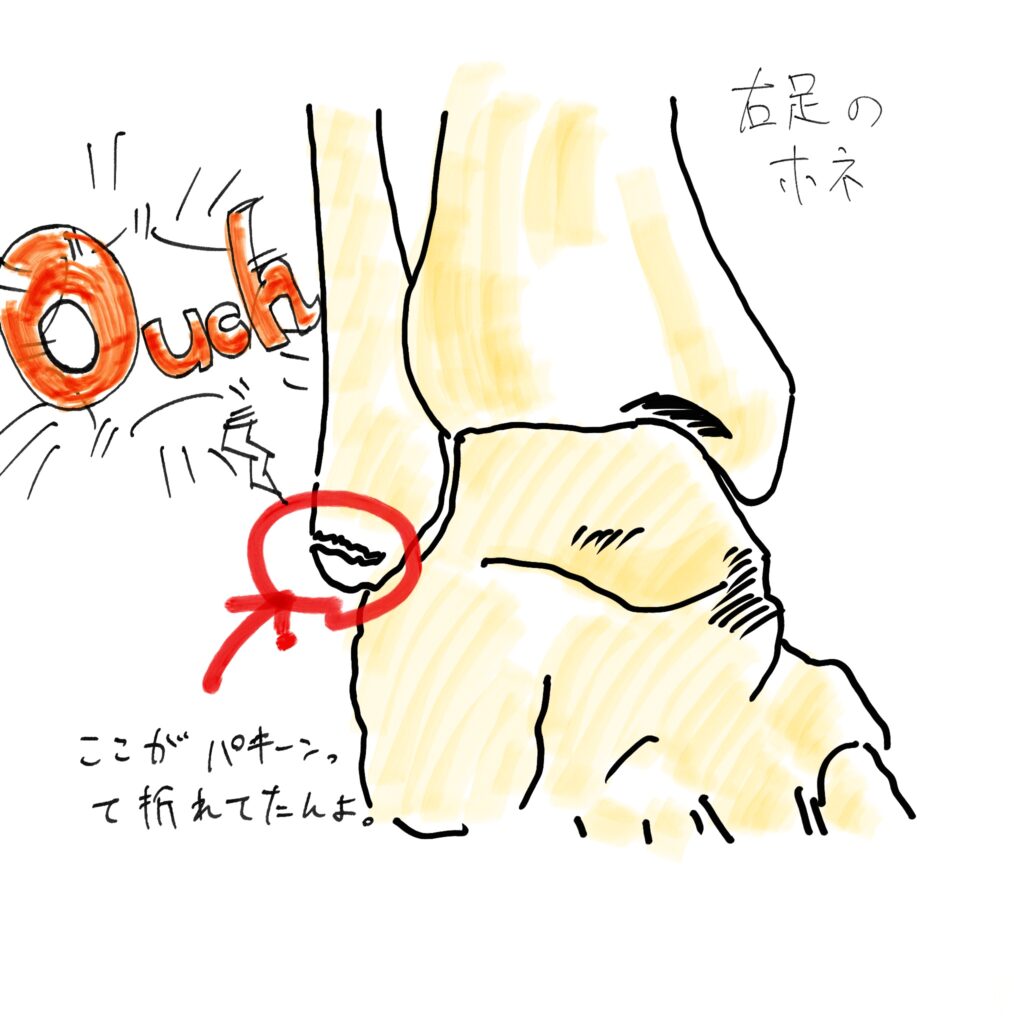 2025年の骨折詳細イラスト